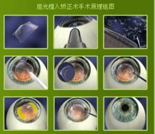 近視雷射矯正術