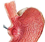 （圖）巨肥厚性胃炎