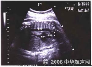 先天性主動脈弓畸形