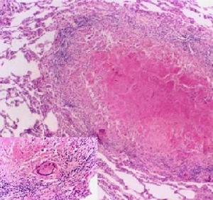 腸系膜淋巴結結核 腸系膜淋巴結結核