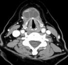 甲狀舌囊腫及瘺管