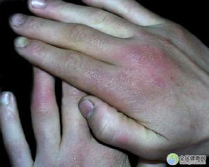 手足發紺症
