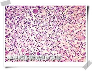 新生兒單純皰疹病毒感染