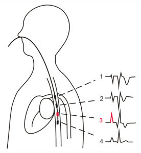 食道調搏 食道調搏
