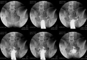 陰道平滑肌肉瘤 陰道平滑肌肉瘤