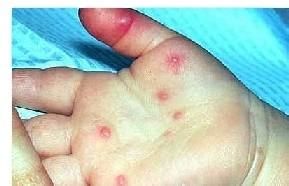 小兒紫斑濕疹綜合徵