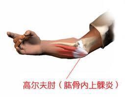 肱骨內上髁注射