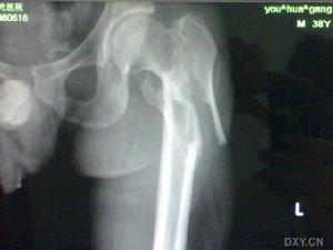 股骨粗隆間骨折