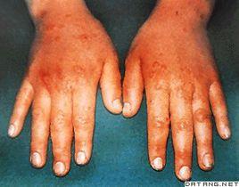 多形性滲出性紅斑 多形性滲出性紅斑