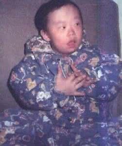 中度精神發育遲滯 中度精神發育遲滯