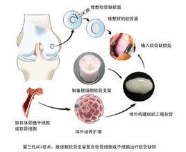 間充質幹細胞移植