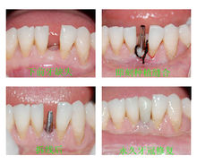 即刻種植牙的過程及效果實拍圖