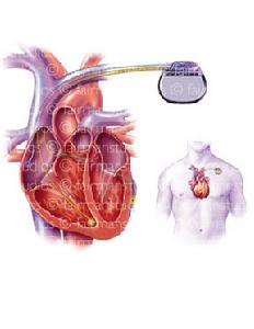 病理性陣發性室性心動過速