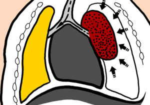 開放性氣胸 開放性氣胸