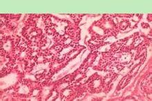 腺導管內乳頭狀瘤 腺導管內乳頭狀瘤