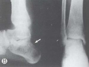 （圖）幼年型慢性粒細胞白血病