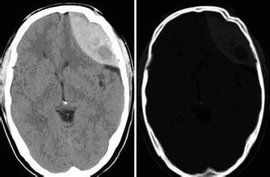 硬膜下血腫 硬膜下血腫