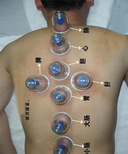 拔火罐的好處 拔火罐的好處