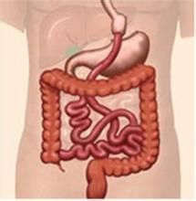 胃繞道 胃繞道