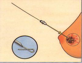 乳腺定位針 乳腺定位針