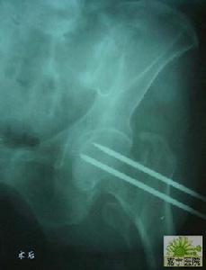 股骨粗隆間骨折