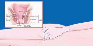 肛門乳頭瘤 肛門乳頭瘤