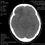 顱內壓增高綜合症
