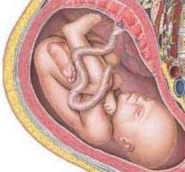 臍帶纏繞 臍帶纏繞