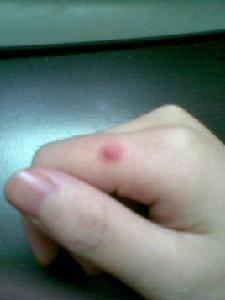 凍爛腫瘡 凍爛腫瘡