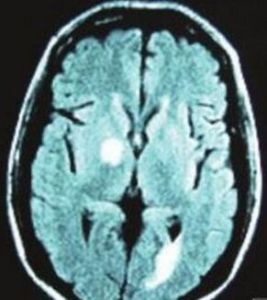 腦型瘧疾 腦型瘧疾