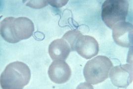 回歸熱病 回歸熱病