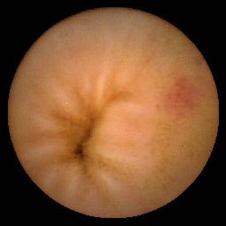 （圖）小腸血管瘤