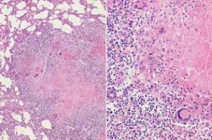 急性粟粒性肺結核 急性粟粒性肺結核