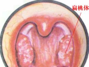 急性舌扁桃體炎