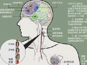 額葉癲癇扣帶回發作