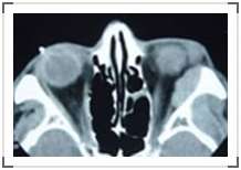 遲發性皮膚卟啉病