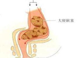 糞便嵌塞 糞便嵌塞