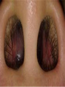 下鼻甲肥大 下鼻甲肥大