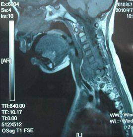 腸源性囊腫 腸源性囊腫