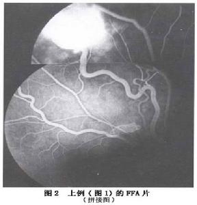 視網膜毛細血管血管瘤