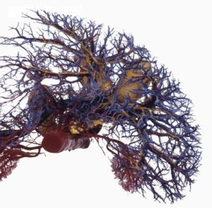 門靜脈海綿樣變 門靜脈海綿樣變