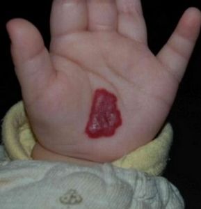 嬰幼兒血管瘤