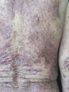 熱性蕁麻疹 熱性蕁麻疹