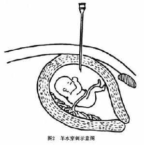 埃萊爾-當洛綜合徵