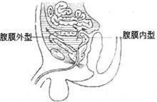 膀胱破裂 膀胱破裂