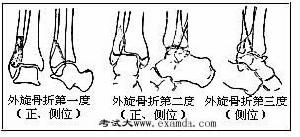 韌帶撕脫傷 韌帶撕脫傷