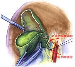 胰頭癌梗阻性黃疸綜合徵 胰頭癌梗阻性黃疸綜合徵