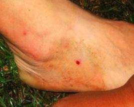 蜈蚣中毒 蜈蚣中毒