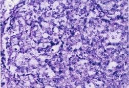 間變性T細胞淋巴瘤 間變性T細胞淋巴瘤