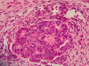 腎母細胞癌